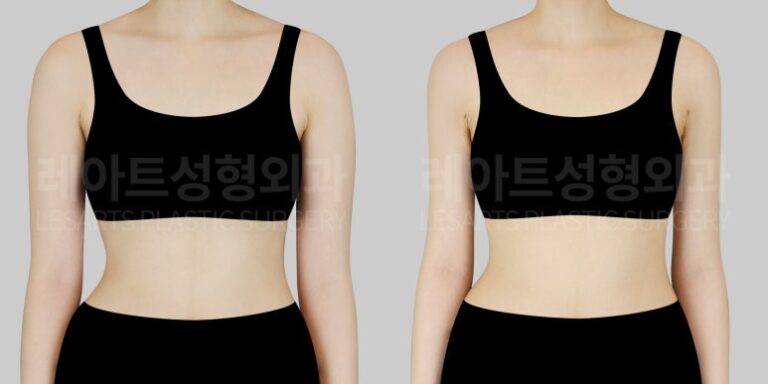 팔 지방흡입 전후사진 앞모습 레아트 성형외과