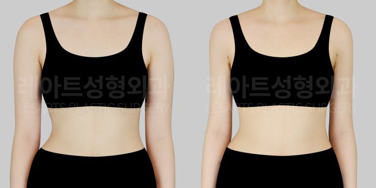 팔 지방흡입 전후사진 앞모습 레아트 성형외과