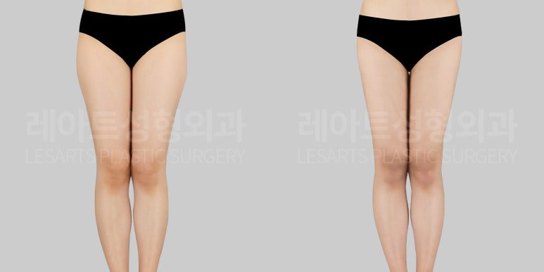승마살 지방흡입 전후사진