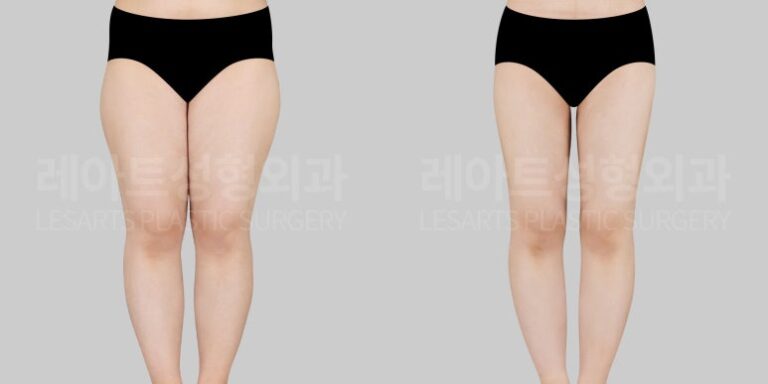 허벅지지방흡입 전후사진 앞모습 - 레아트 성형외과