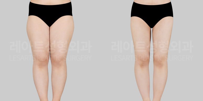 허벅지지방흡입 전후사진 앞모습 - 레아트 성형외과