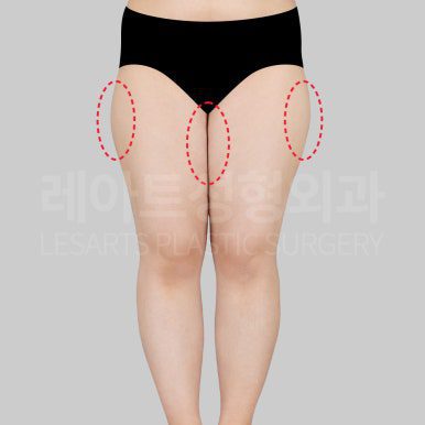 c-thigh-liposuction-post20-13