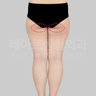 c-thigh-liposuction-post20-14