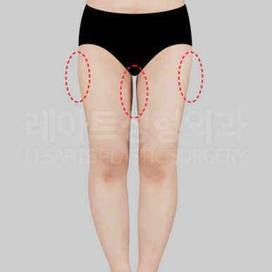 c-thigh-liposuction-post20-15