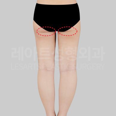 c-thigh-liposuction-post20-16