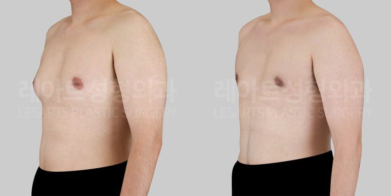 여유증 수술 잘하는 곳 레아트 성형외과
