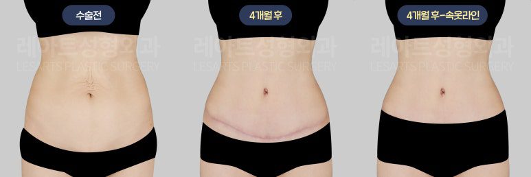 복부거상 수술후 경과 전후사진