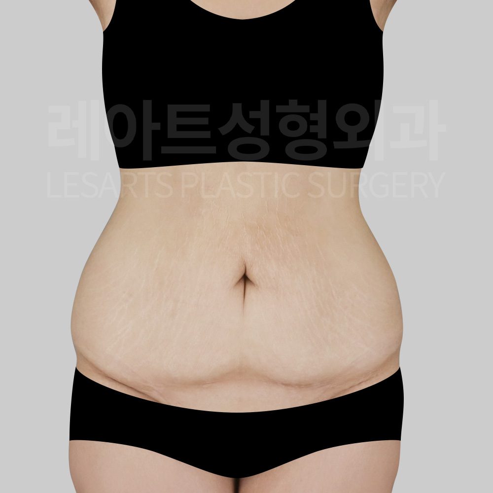 l-abdominoplasty-post16-01