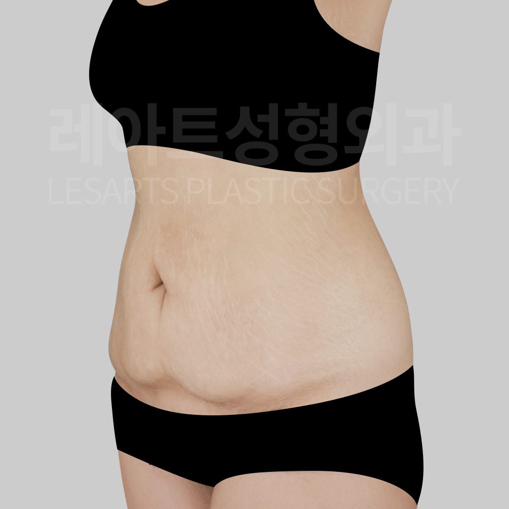 l-abdominoplasty-post16-03