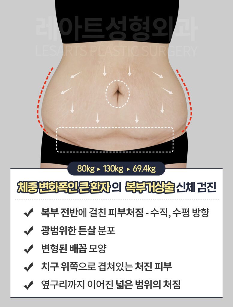 L-type (확대) 복부 거상술 7개월 변화 과정 [닥터's 노트 by.이국한 원장]
