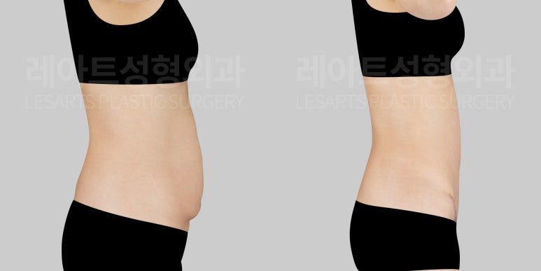 복부거상술 수술 전후 비교 사진 레아트 성형외과