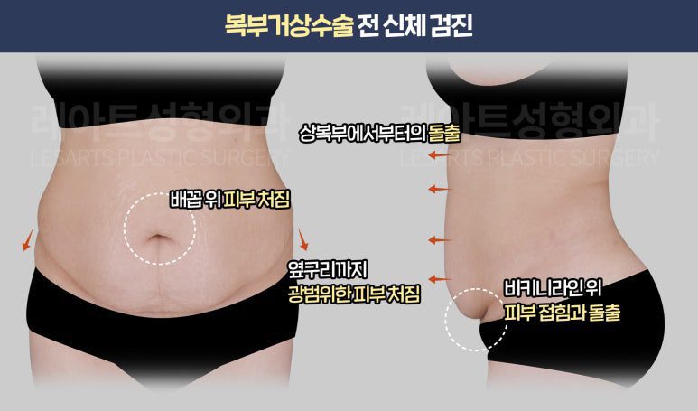 복부거상술 전 신체검진 - 레아트 성형외과
