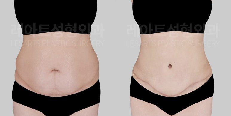 복부거상 전후 비교 앞모습- 레아트 성형외과