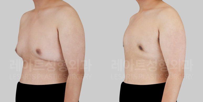 여유증 수술 전후사진 레아트 성형외과