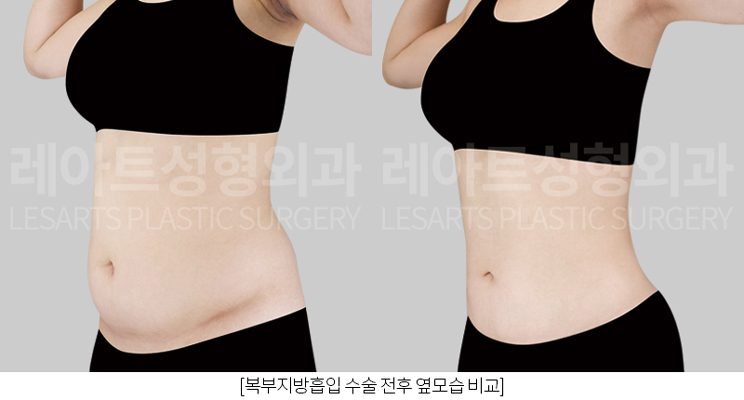 강남 복부지방흡입 전후 레아트 성형외과