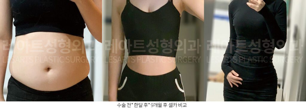 복부 지방흡입 셀카전후사진