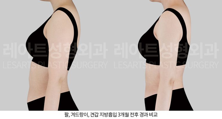 팔지방흡입 전후사진 레아트 성형외과