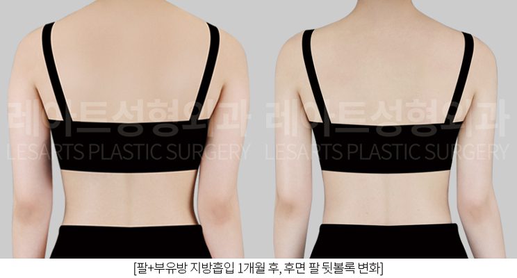 팔 지방흡입 전후비교 - 레아트 성형외과