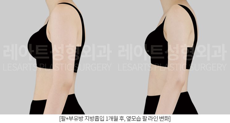 팔 지방흡입 후 옆모습 변화
