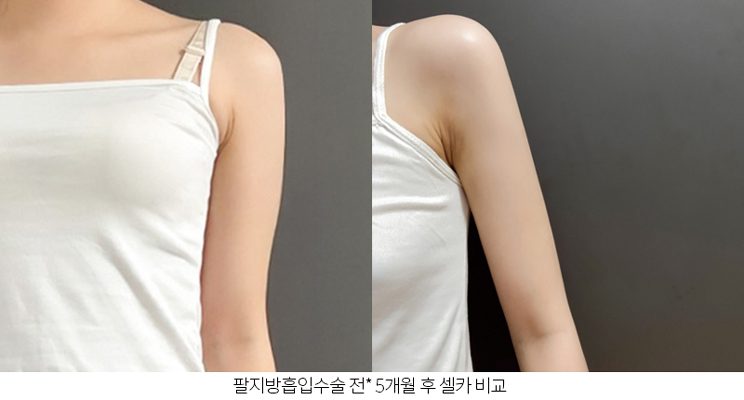 팔 지방흡입 후 셀카 변화 - 레아트 성형외과