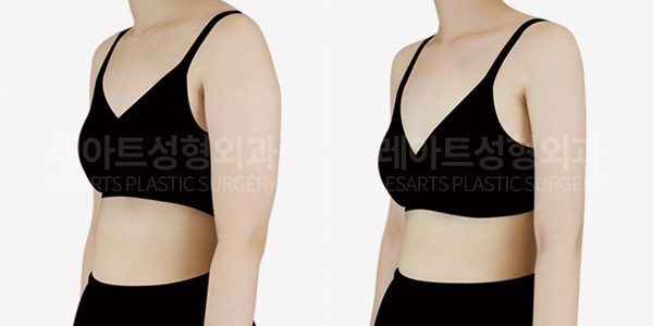 팔지방흡입 전후사진 반측면 레아트 성형외과