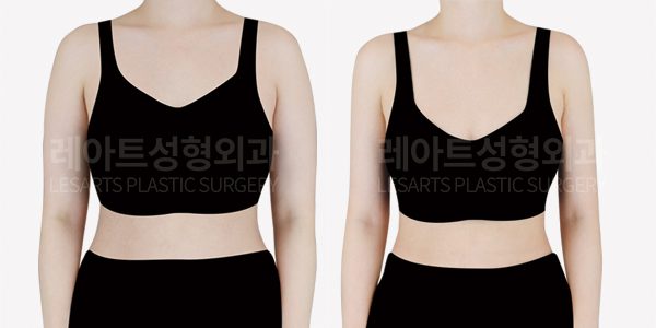 팔지방흡입 전후 앞모습 비교
