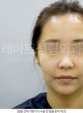 얼굴 지방이식 전 사진
