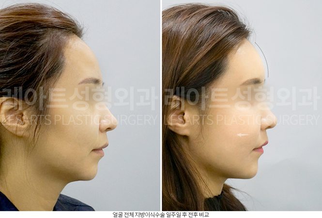 실리프팅 병행 얼굴지방이식 전후 - 레아트성형외과