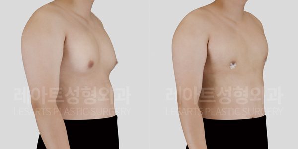 여유증 2주후 전후사진 레아트 성형외과