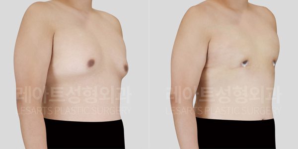강남 여유증 수술 전후사진