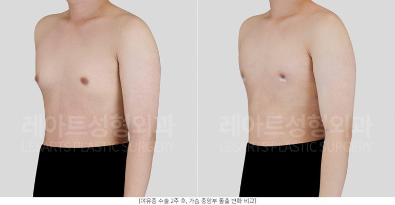 여유증 수술 전후사진 레아트 성형외과