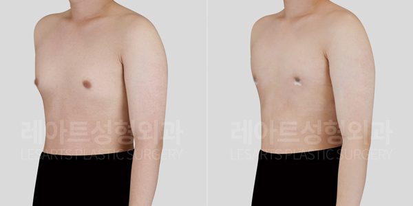 여유증 수술 잘하는곳 레아트 성형외과