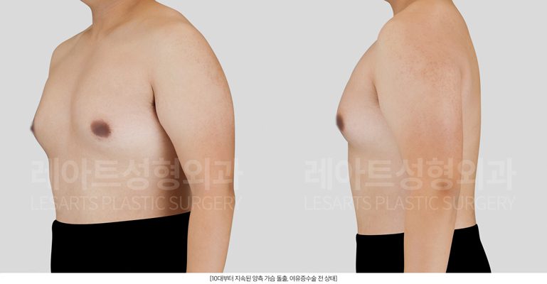 여유증수술 전 상태 및 환자 체형