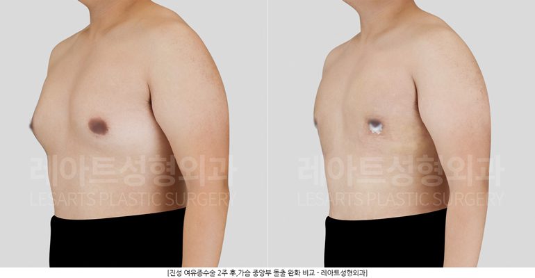 여유증수술 전후 비교 - 레아트성형외과