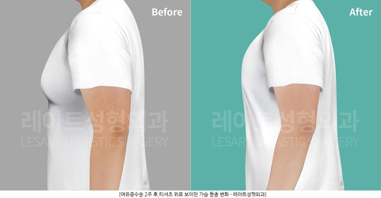 티셔츠 핏 변화 전후 - 레아트성형외과
