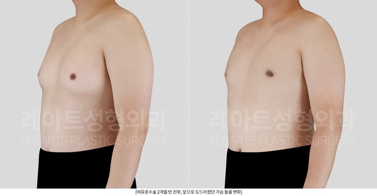 여유증 수술 전후 옆모습 비교 레아트 성형외과