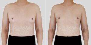 짝가슴 여유증수술로 달라진 티셔츠핏과 일상 생활의 변화