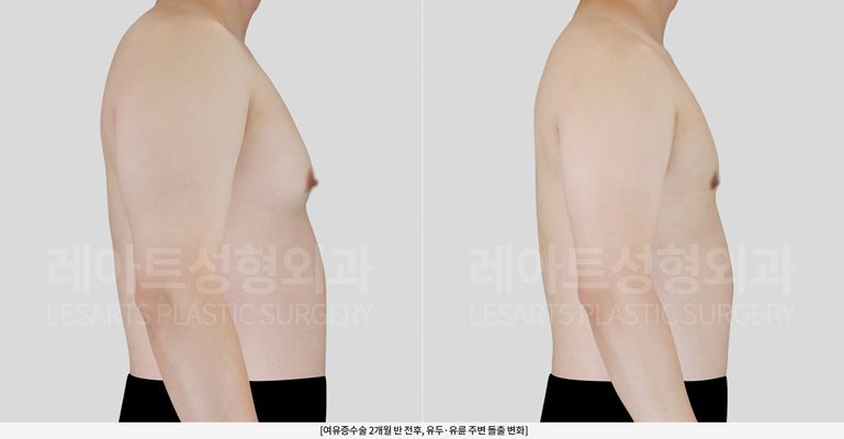여유증수술 전후 레아트 성형외과