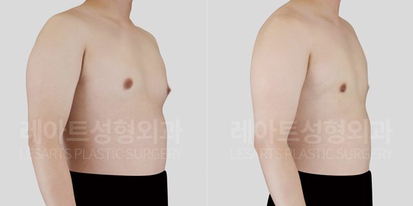 여유증 수술 옆모습 전후사진 레아트 성형회과