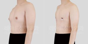여유증 수술 전후 옆모습 비교 레아트 성형외과