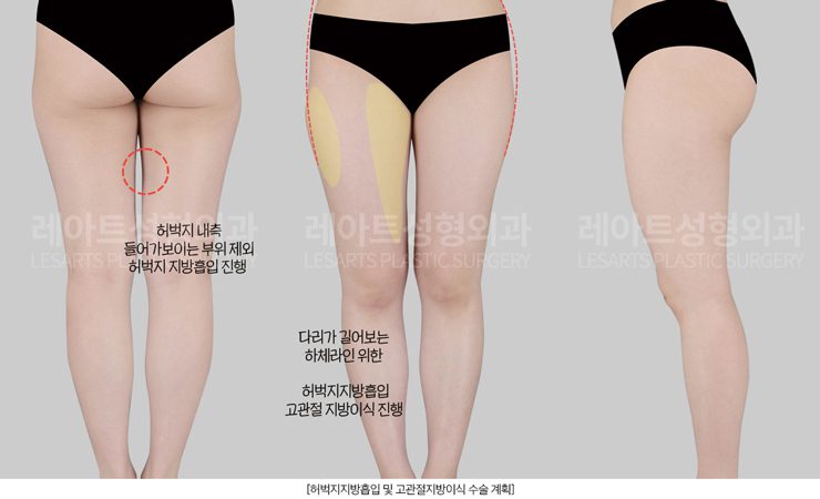 허벅지지방흡입 전 하체라인 분석 - 레아트성형외과