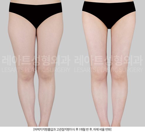 허벅지지방흡입 전후 비교 - 레아트성형외과