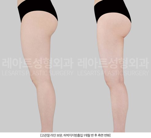 허벅지지방흡입 측면 변화 - 레아트성형외과
