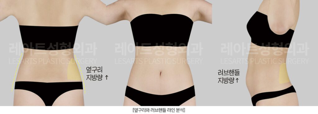 허벅지라인 분석 - 레아트성형외과