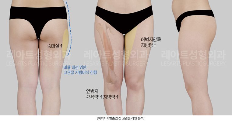 허벅지라인 분석 - 레아트성형외과