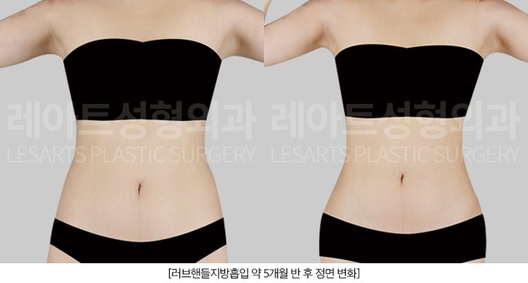 허리라인 변화 - 레아트성형외과