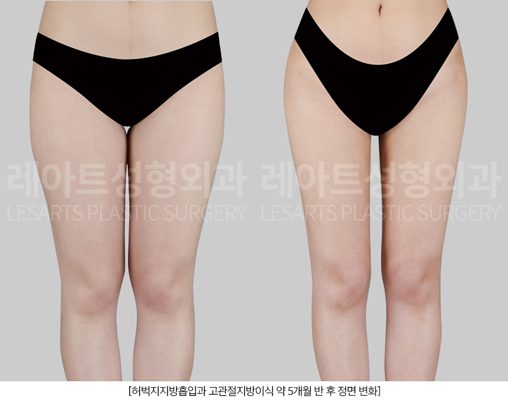 허벅지지방흡입 전후 - 레아트성형외과