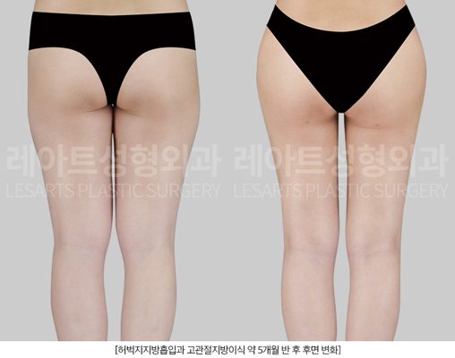 승마살 제거 효과 - 레아트성형외과