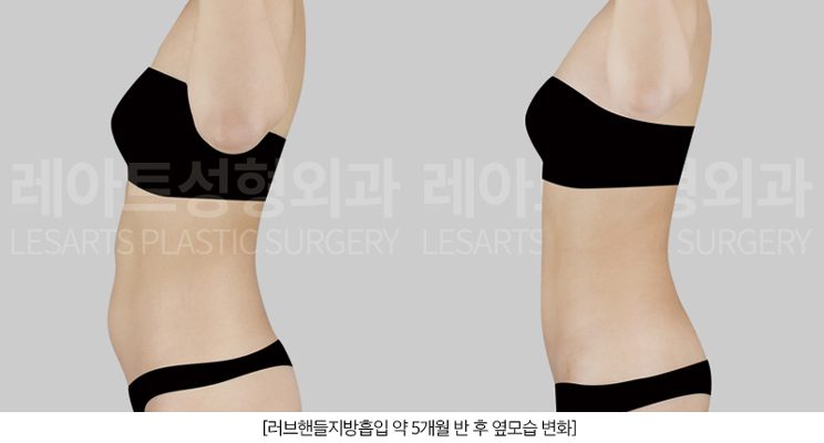 러브핸들 지방흡입 전후 모습