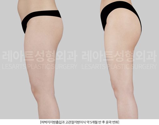 허벅지 지방흡입 후 둘레 감소
